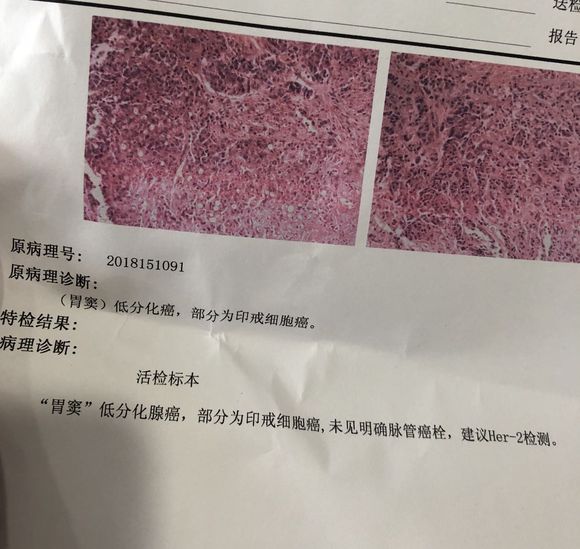 低分化印戒细胞癌