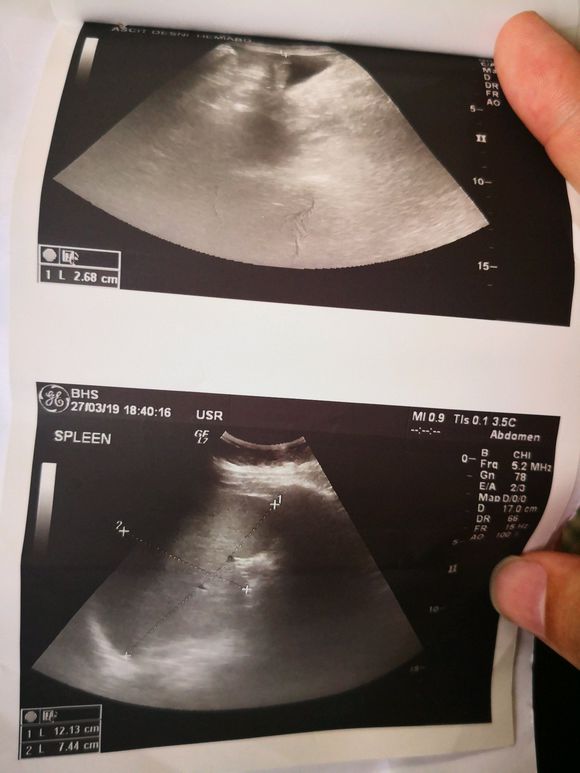 昨天查出肝癌。这么办接下来的路这么走？