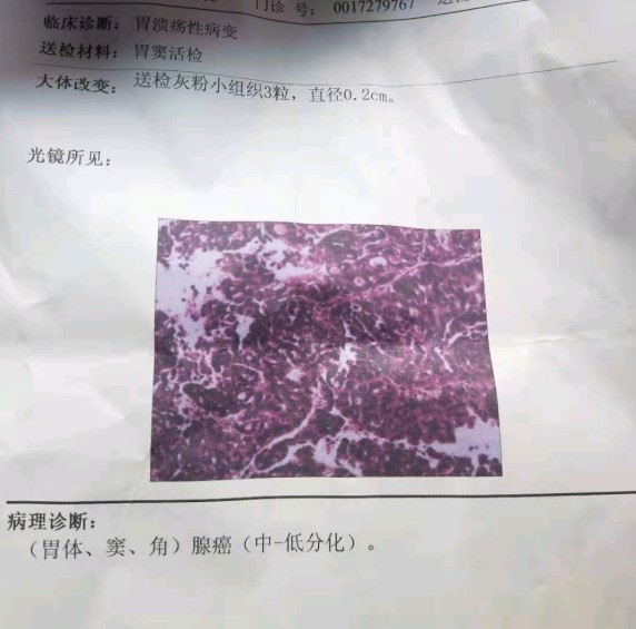 求：中低分化的胃腺癌到底可不可怕？