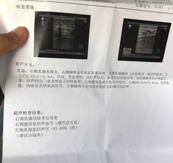 麻烦帮忙看下乳腺癌术后检查报告