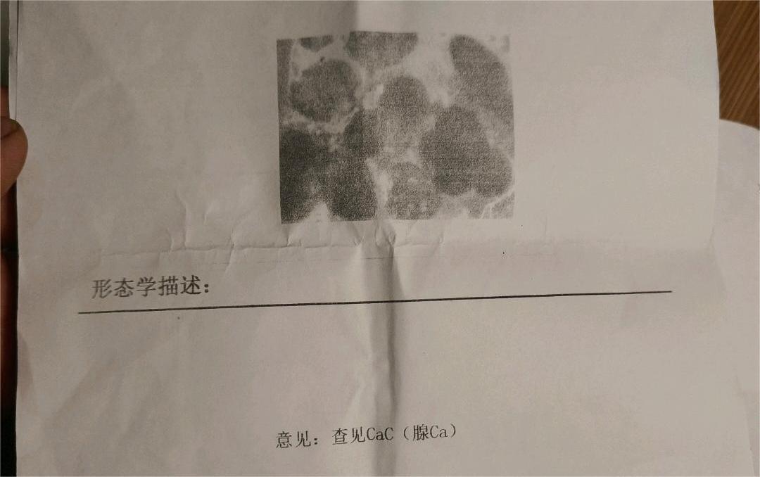 腹腔积液，肿瘤